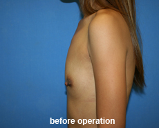 plastic-surgery-breast-augmentation